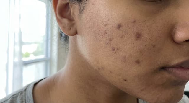 Acne Scars vs. Acne Marks: The Difference Matters for Treatment