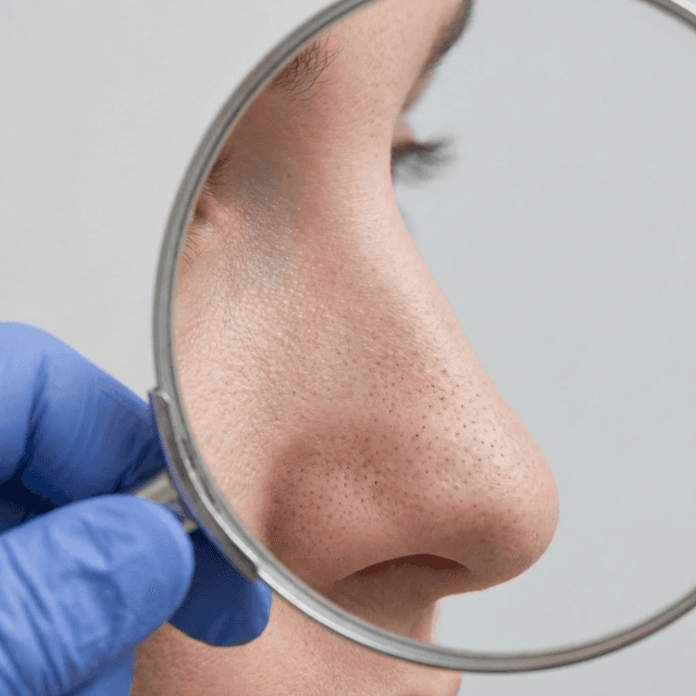 Blackheads (Open Comedones): Why They're Dark, How to Remove Them Safely, and What Actually Prevents Them