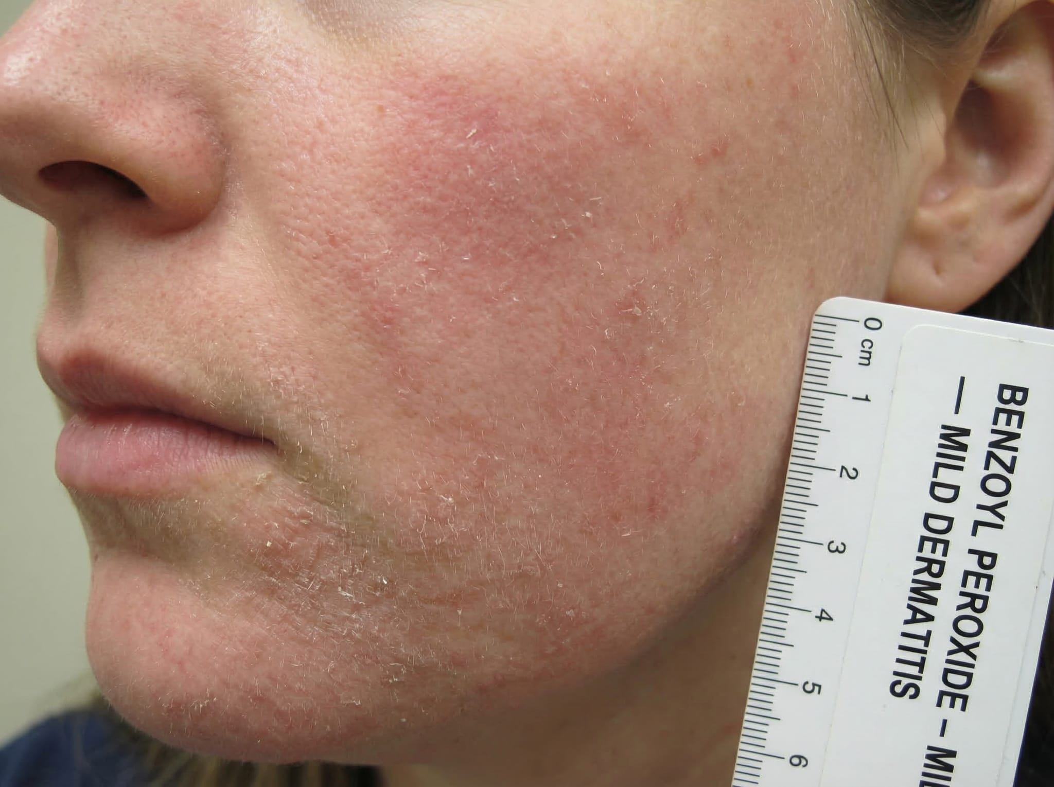 Skin irritation and redness from benzoyl peroxide use