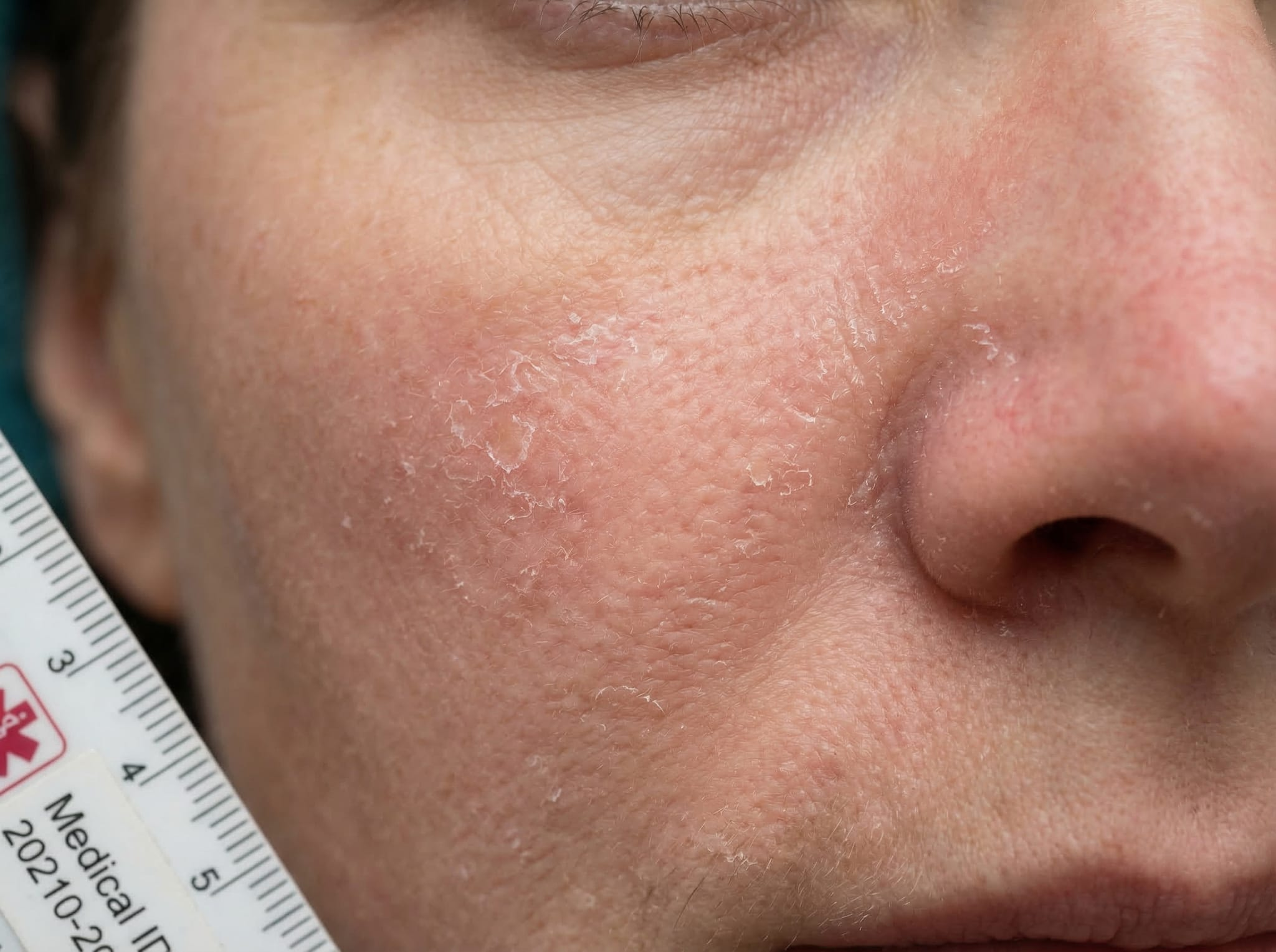 Skin dryness and peeling caused by retinoid use
